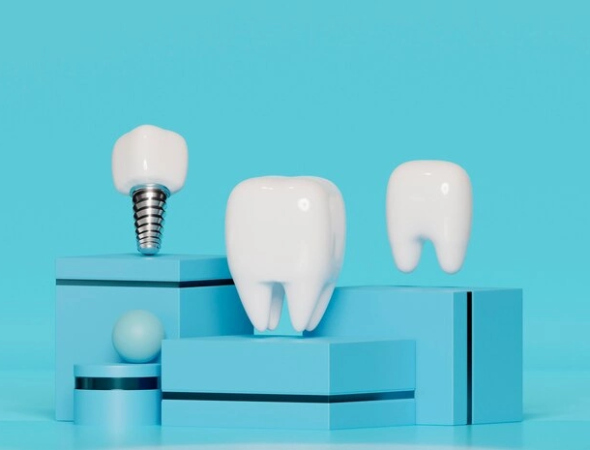Імплантація зубів, її види та ефективність